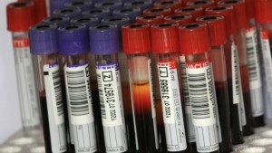 Диагностика колоректального рака на основе результатов стандартных тестов крови